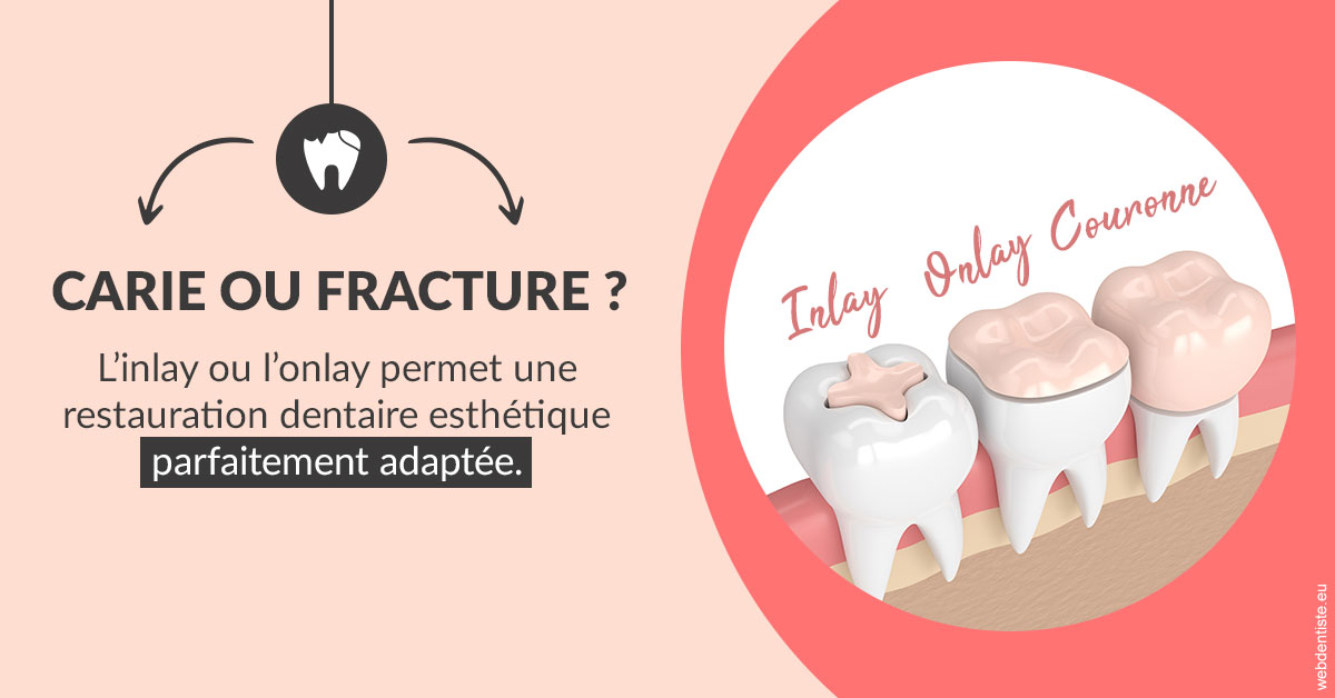 https://dr-sadoul-frederic.chirurgiens-dentistes.fr/T2 2023 - Carie ou fracture 2