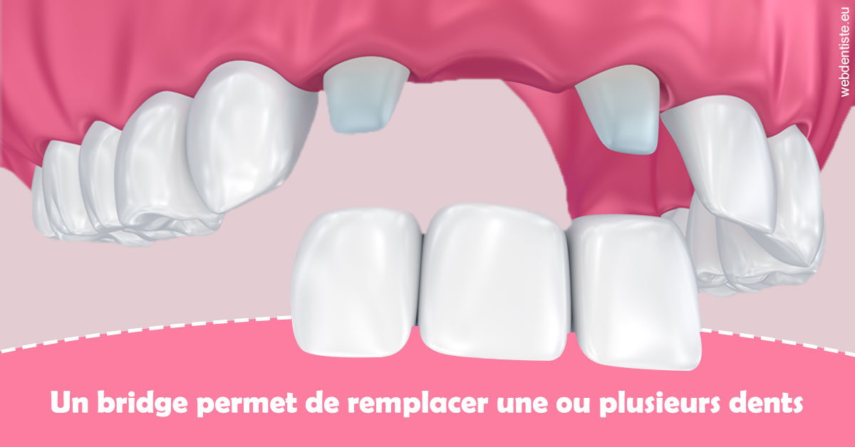 https://dr-sadoul-frederic.chirurgiens-dentistes.fr/Bridge remplacer dents 2