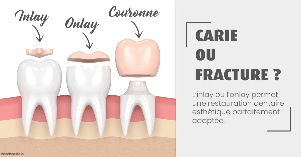 https://dr-sadoul-frederic.chirurgiens-dentistes.fr/T2 2023 - Carie ou fracture 1