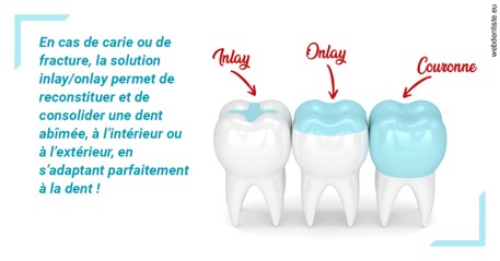 https://dr-sadoul-frederic.chirurgiens-dentistes.fr/L'INLAY ou l'ONLAY