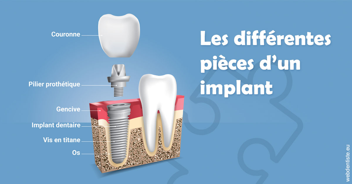 https://dr-sadoul-frederic.chirurgiens-dentistes.fr/Les différentes pièces d’un implant 1
