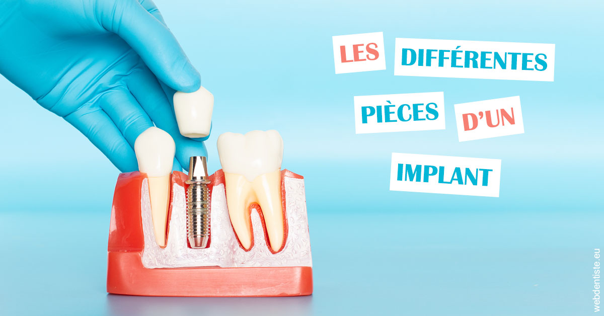 https://dr-sadoul-frederic.chirurgiens-dentistes.fr/Les différentes pièces d’un implant 2